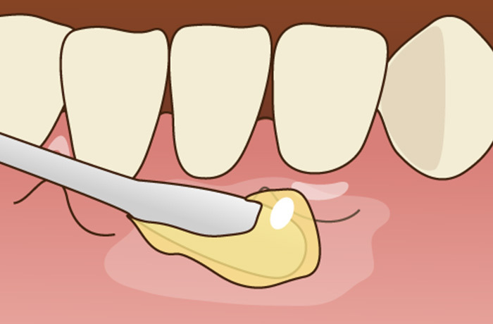 ジェルタイプの表面麻酔を歯茎に塗るイラスト
