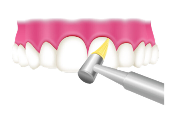 専用の器具を用いて歯石やバイオフィルムを除去する、歯科医院でのクリーニングのイラスト