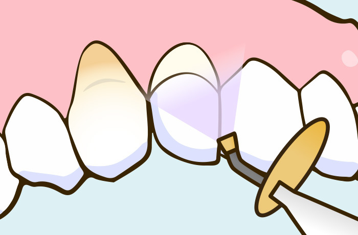 楔状欠損部分をコンポジットレジンで詰める治療のイラスト