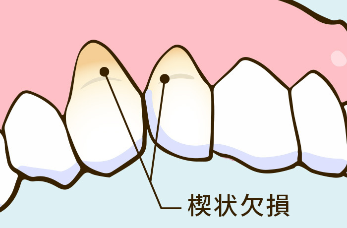 上顎の歯と歯茎の間が楔型に削れているイラスト