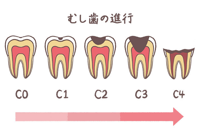 COからC4までのむし歯が進行していく過程を描いた臼歯のイラスト
