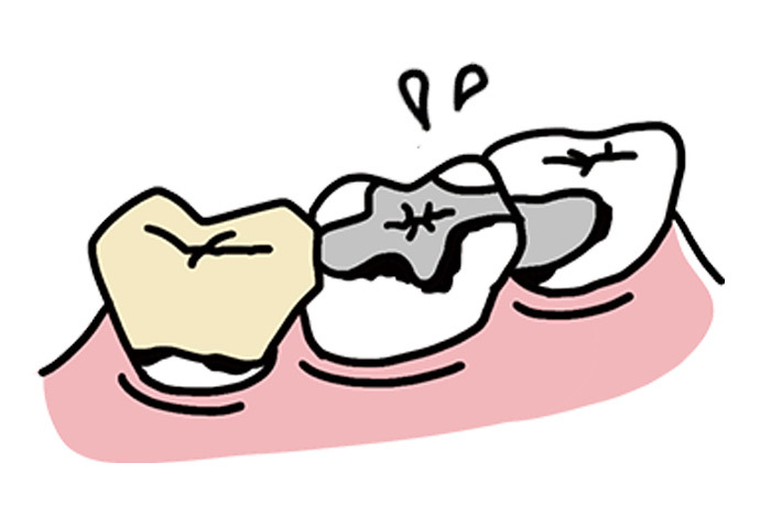 銀色の詰め物の下が黒く虫歯になってしまっている臼歯のイラスト