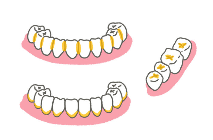 歯と歯の間、噛み合わせの面にある溝、歯と歯茎の境目に黄色い印が付いた、磨き残しやすい場所を示したイラスト