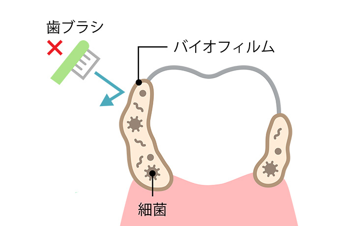 歯ブラシでも落とせない、歯の表面に付いたバイオフィルムのイメージイラスト