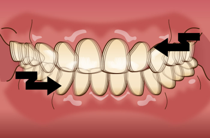 歯ぎしりのひとつで、ギリギリと歯を動かすグラインディングのイメージイラスト