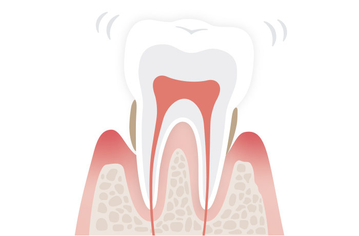 歯根にたくさん歯石が付き、歯槽骨も溶けしまい歯がグラつく様子を表したイラスト