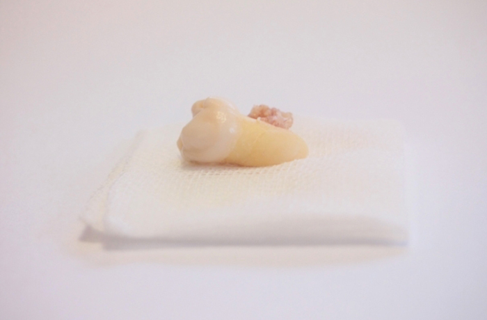 ガーゼの上に乗っている、抜歯された臼歯の画像