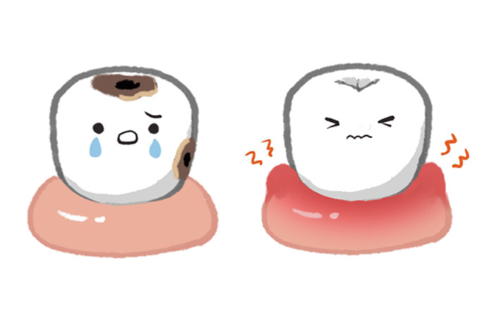 虫歯になって悲しむ歯と、歯ぐきが赤く腫れて痛そうな顔をする歯のイラスト