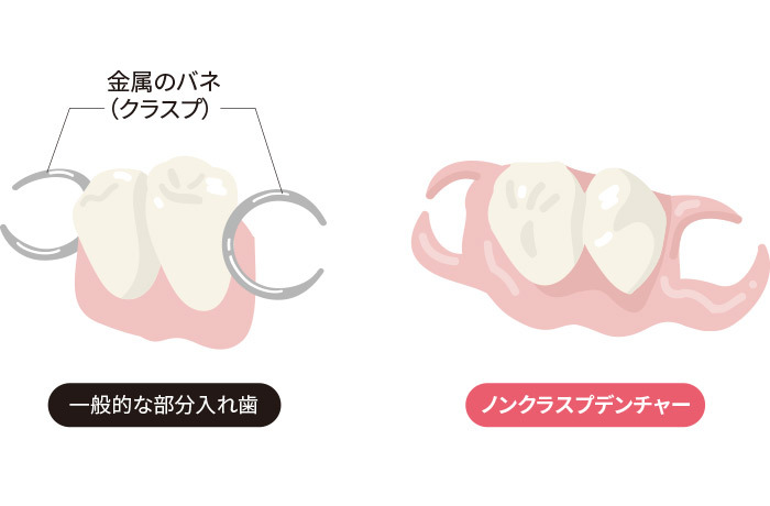 金属のバネがある一般的な部分入れ歯とノンクラスプデンチャーを比較したイラス