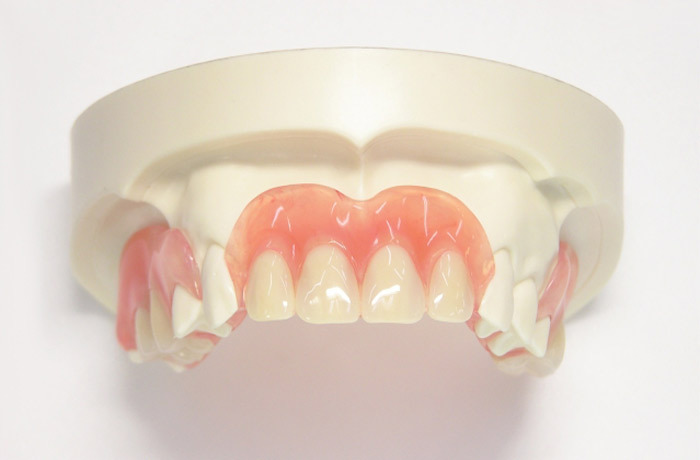 歯科模型にノンクラスプデンチャーを装着した、正面からみたときの装着イメージ画像