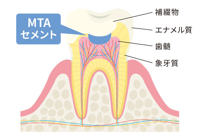 歯の神経を保護するために使用されるMTAを使った虫歯治療のイメージ