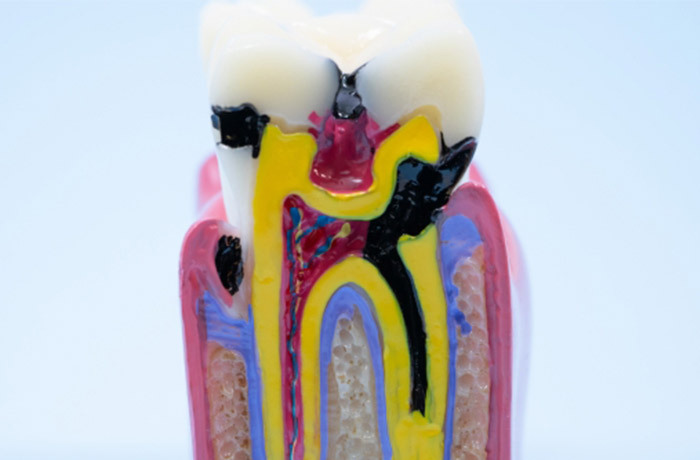 感染が歯の内部にまで広範囲に及んでいる状態の臼歯断面の模型
