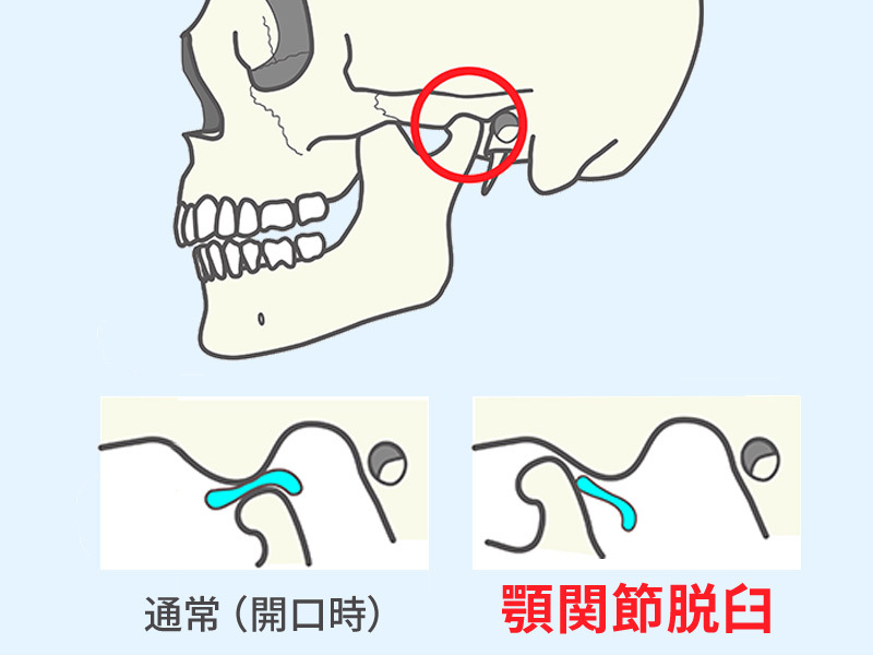 下あごの骨が通常の位置から前方へ外れた場合を表したイラスト