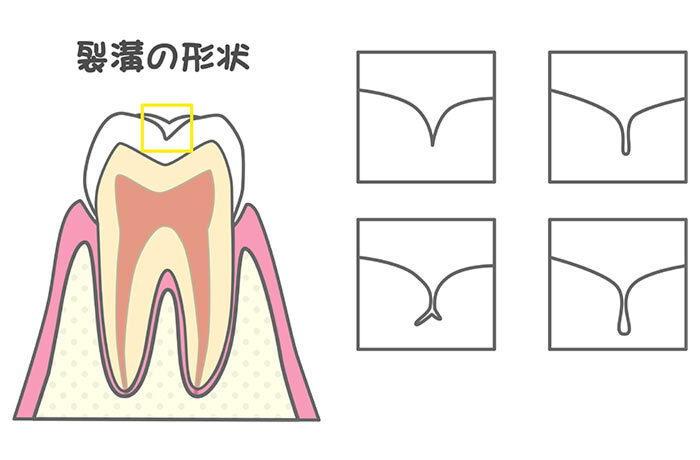 虫歯になりやすい歯の溝(裂溝)の深さや形状の違いを示す解説図