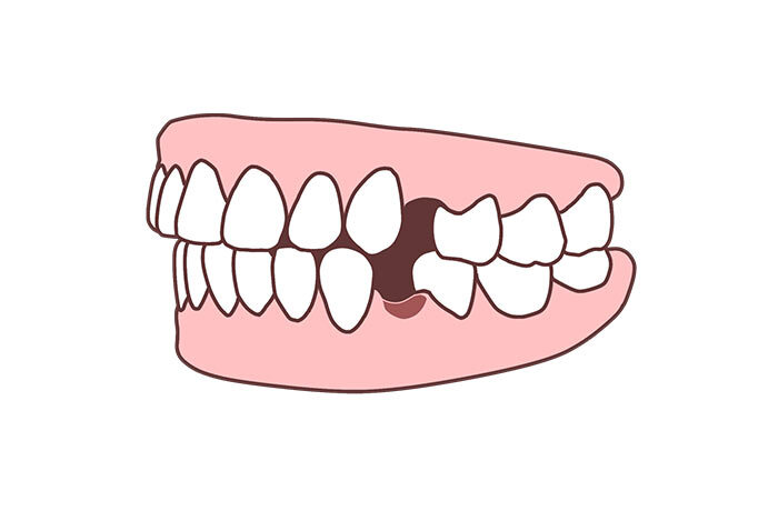 左上下4番の歯が抜けた状態を表した歯の模型イラスト
