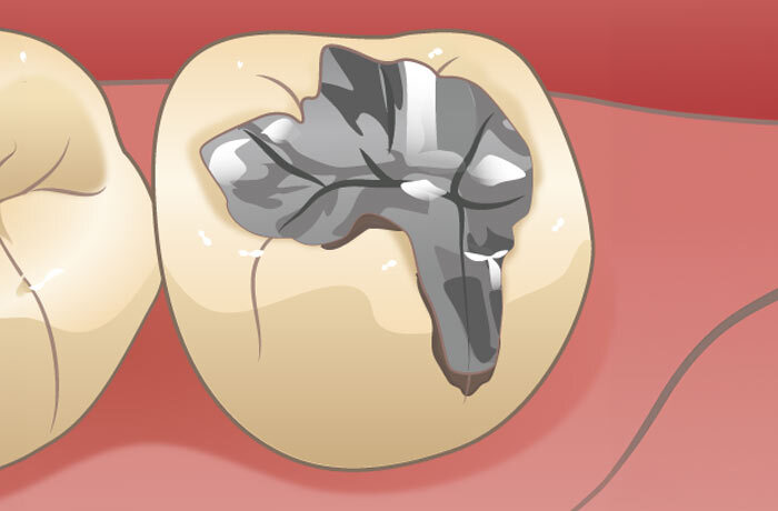 詰め物の下が茶色く虫歯になってしまっている奥歯のイラスト
