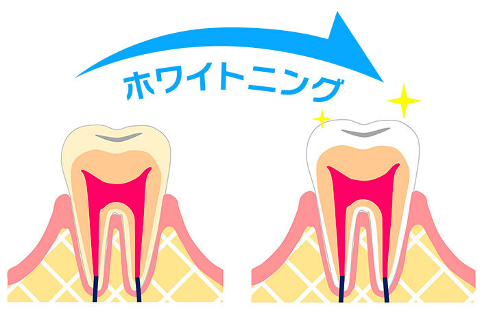 黄色く色素沈着した歯をホワイトニングして白くなった移り変わりを示すイラスト